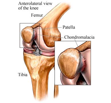 damaged cartilage under kneecap symptoms